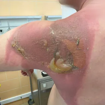 Сильный зуд и покраснения на спине: в Татарстане мужчина и ребенок получили ожоги после стирки белья