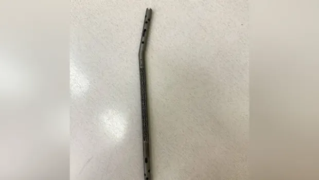 В Казани впервые применили уникальный 3D-имплант для лечения тяжёлой костной инфекции