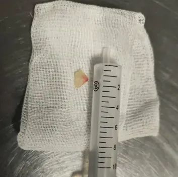 В Казани пенсионерку спасли после удушья квашеной капустой