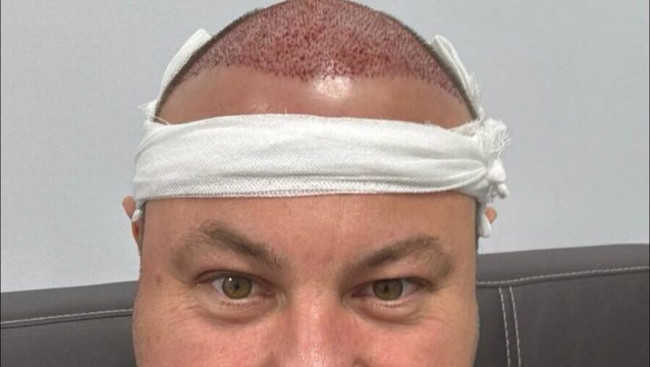 Певец Ильнар Сайфиев перенес операцию по пересадке волос в Казани